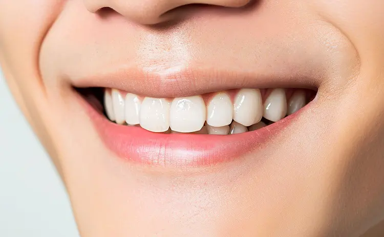 マイルドホワイトニング