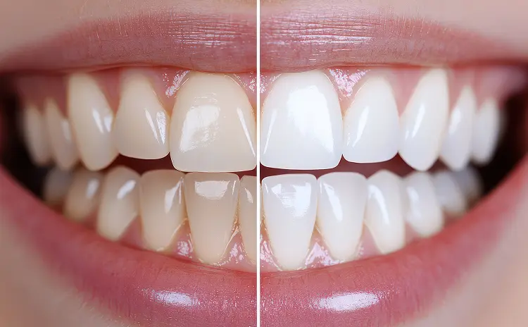 強力ホワイトニング